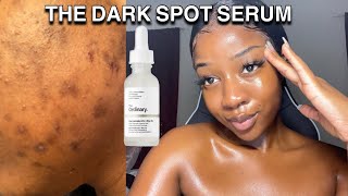 HOW TO GET RID OF DARK SPOTS WITH ONE PRODUCT  The ordinary [upl. by Yule478]