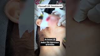 Benefits of Thread Lift Treatment threadlift nonsurgicallift antiaging skinrejuvenation [upl. by Naillil562]