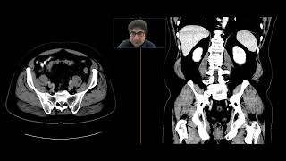 Appendiceal adenocarcinoma [upl. by Aizatsana]