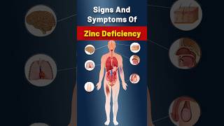 Zinc Deficiency  What Are The Critical Symptoms Of Zinc Deficiency zincdeficiency zinc [upl. by Anna-Diana]