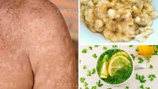 3 Natural Remedies for Treating Tinea Versicolor at Home Pityriasis Versicolor [upl. by Charmion]