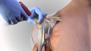 Arrow® EZIO® Proximal Humerus Site Animation [upl. by Calley]