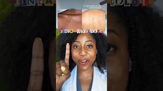 How to Treat Tinea Versicolor skincare tineaversicolor [upl. by Lyontine]