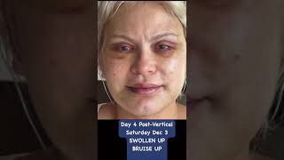 DayByDay Facelift Recovery amp Transformation [upl. by Zednanref]