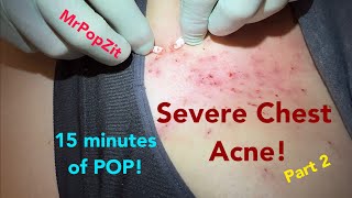 Dozens of clogged pores over the sternum extracted Blackheads whiteheads removed [upl. by Asyral]