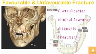 Favourable And Unfavourable Fracture [upl. by Ybroc]