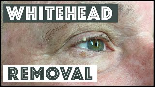 Removing a whitehead from the conjunctival rim [upl. by Idyak709]