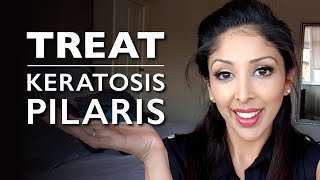 KERATOSIS PILARIS from DOCTOR V  KP Treatment chicken skin  How to treat KERATOSIS PILARIS  DR V [upl. by Jezabelle]