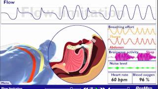 Understanding Sleep Disordered Breathing [upl. by Linetta]