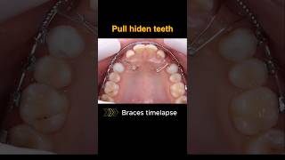 Pull x2 hiden teeth with braces braces orthodontist bracesoff dentist [upl. by Blasius715]