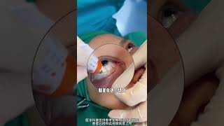 How to apply eye ointment medical plasticandbeauty 搞笑 plastic [upl. by Llessur]