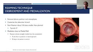 Practical Tips for Acetabular Preparation in THA [upl. by Eikcor]