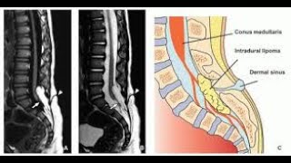 Spinal Dermal Sinus  Causes and Features [upl. by Medeah]