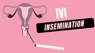 How to do at Home IVI Insemination [upl. by Anairol598]