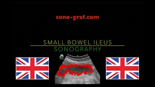 Sonography  Small Bowel Ileus [upl. by Adamsen689]