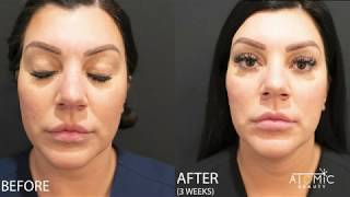 How to get a SLIMMER JAW LINE  Botox to the Masseter Muscle  Atomic Beauty Med Spa [upl. by Lenka]