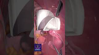 Laparoscopic Tissue Removal shorts medicalsurgery [upl. by Ayanej]