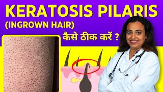 Keratosis Pilaris Treatment  Ingrown Hair on Arms Legs Face Buttocks  Home Remedies in Hindi [upl. by Sihon177]