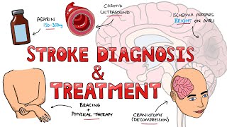 Stroke Diagnosis and Treatment  Acute and Long Term Treatment of Ischemic and Hemorrhagic Stroke [upl. by Wiedmann]