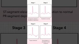 Acute Pericarditis ECG Stages 14 [upl. by Wettam]