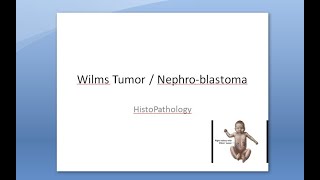 Pathology 700 a Wilms Tumor Kidney Nephroblastoma embryonal WAGR syndrome microscopy cancer child [upl. by Zarihs]