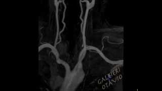 ANGIORMANATOMIA DOS VASOS CERVICAIS [upl. by Natal]