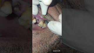 جير الاسنان ادى لانحسار اللثة  تنظيف  dentist stitch [upl. by Erroll]