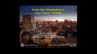 SIRRFS Webinar 10913 Portal Vein Embolization in Liver Cancer Patients [upl. by Spada]