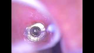 1 Dental Implant Broken Screw Retrieval Method  BioMet 3i DR GERARD CUOMO [upl. by Nnyleak]