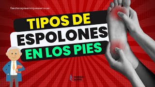 TIPOS DE ESPOLONES EN LOS PIES O EL TALÓN 👣 [upl. by Etta]