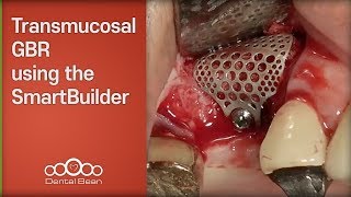 Transmucosal GBR using the SmartBuilder  Dr Kim Yongjin [upl. by Caro430]