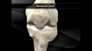 Meniscal Cinch [upl. by Sharline]