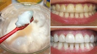 How To Whiten Your Yellow Teeth Naturally At Home दांत चमकानाTooth Whitening [upl. by Aninaj]