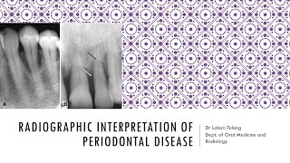 Radiographic Interpretation of Periodontal disease [upl. by Reisfield142]