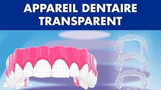 INVISALIGN  Traitement dappareil dentaire TRANSPARENT © [upl. by Rhodes]