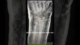 fracture anatomy orthopaedics plaster hospital treatment recover trauma ortho treatments [upl. by Casimire]