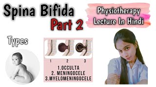 Spina Bifida Occulta Meningocele Myelomeningocele medicalstudentphysiotherapyspinabifida [upl. by Clementas]