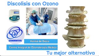 Ozonoterapia intradiscal  Discolisis [upl. by Lam]