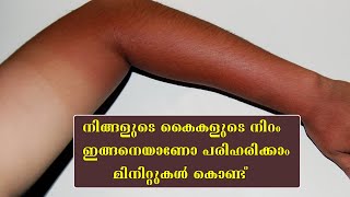 നിങ്ങളുടെ കൈകള്‍ ഇങ്ങനെയാണോ വിഷമിക്കേണ്ട വെളുപ്പിക്കാം Instant sun tan removal [upl. by Lahcar990]