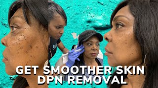 DPN removal for smoother skin [upl. by Ardelle231]