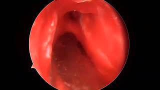 unedited part2 Endoscopic septal correction spurectomy [upl. by Dorinda]