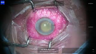 Endophthalmitis Unedited  IOL Removal  Vitrectomy  IVAB  SOI under LA [upl. by Sinned]