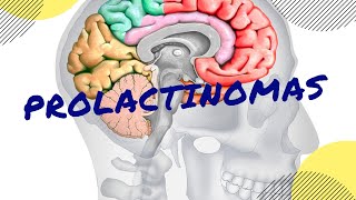 PROLACTINOMAS Causas síntomas diagnóstico y tratamiento [upl. by Rimola]