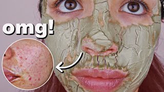 I Used The Aztec Healing Clay Mask On My Skin Everyday For One Week [upl. by Ahtnammas]