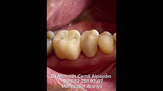 Post corezirkonyum kaplama tedavisiPost corezirconium crown zirconium zirkonyum postcore [upl. by Blakely603]