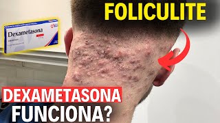 Dexametasona é eficaz para Foliculite [upl. by Ginder]