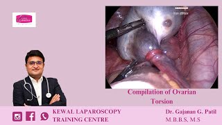 Ovarian Torsion by Dr Gajanan Patil  Kewal Hospital  Laparoscopy Training [upl. by Presber64]