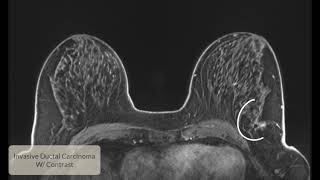 Invasive Ductal Carcinoma [upl. by Penny65]