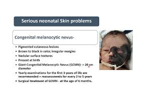 Congenital Melanocytic Nevus  Spot Diagnosis 27  Pediatrics [upl. by Leuneb337]