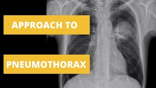 Approach to Pneumothorax  How to Read a Chest X Ray [upl. by Quillan573]